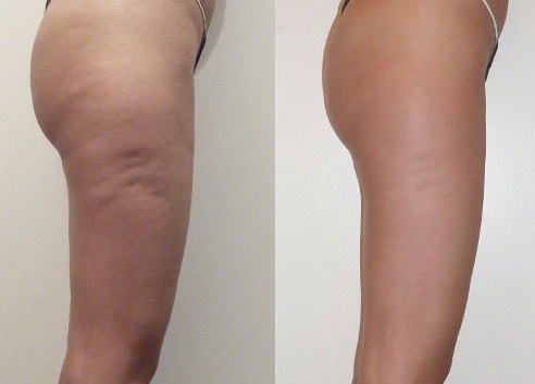 Results of using ultrasonic cavitation on thighs